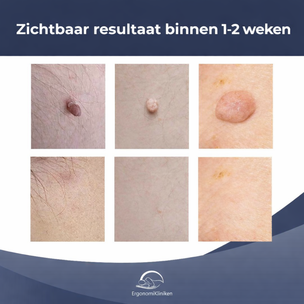 Wrattenverwijderaar Huidtag Verwijderaar Thuis Kit
