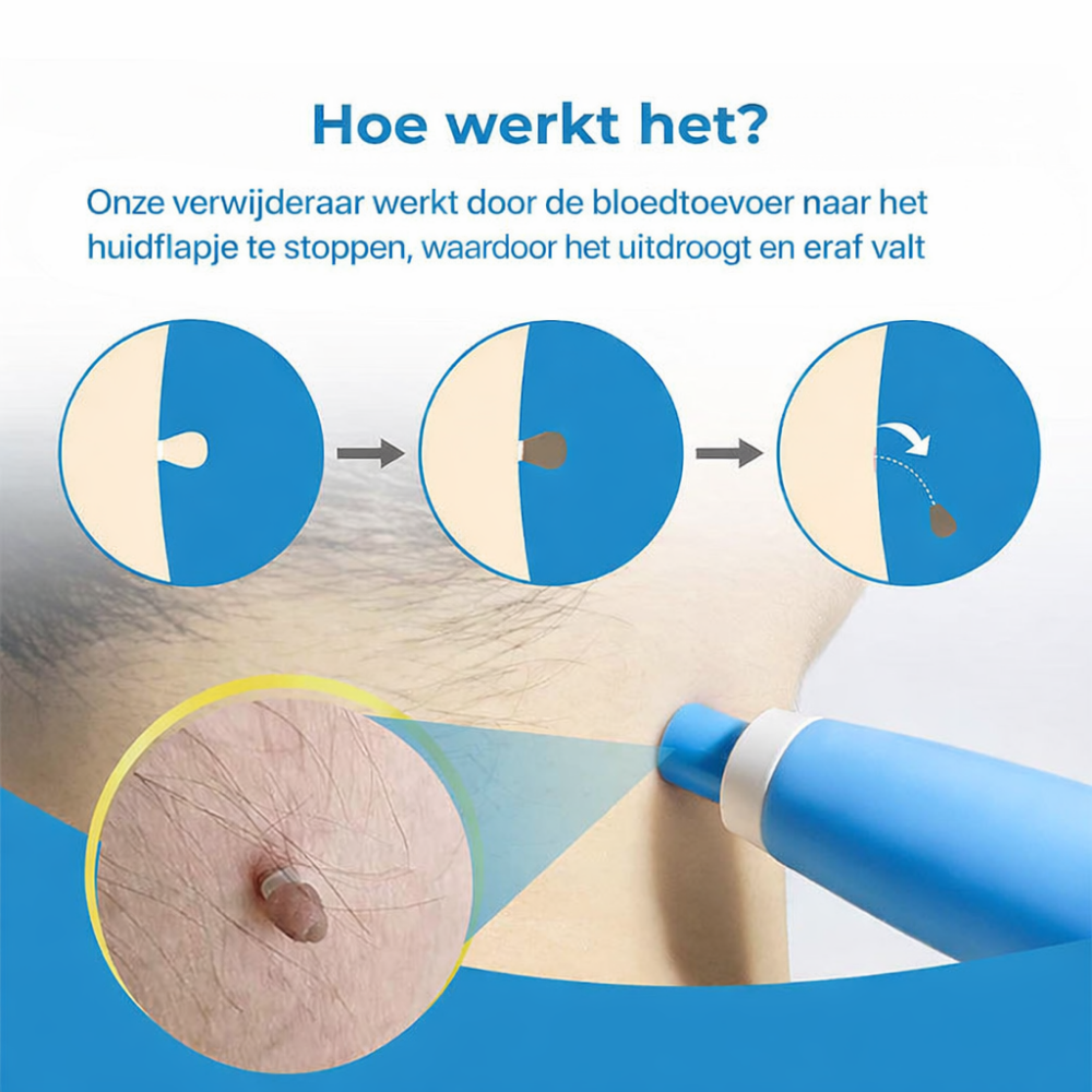 Wrattenverwijderaar Huidtag Verwijderaar Thuis Kit