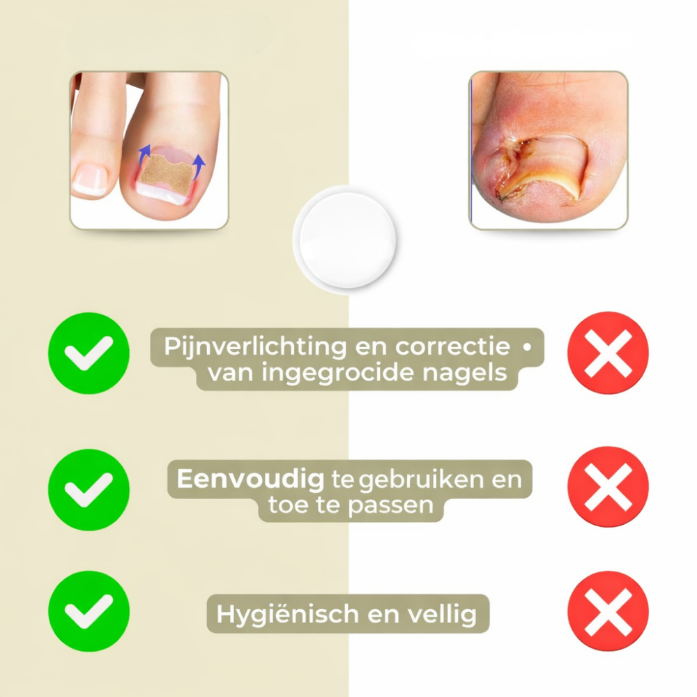 Nagel Correctie Pleisters Ingegroeide Teennagel Behandeling